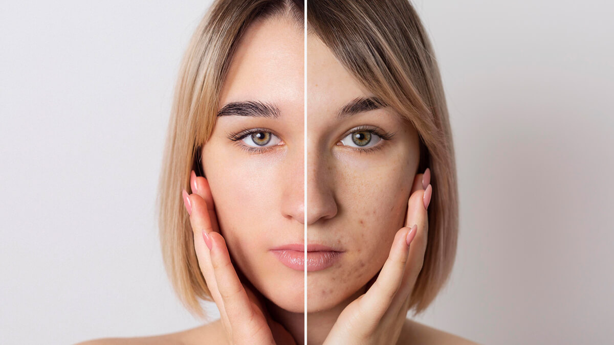 Before and after portrait of a woman with acne scars