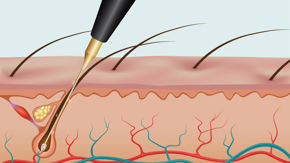 Electrolysis hair removal functionality