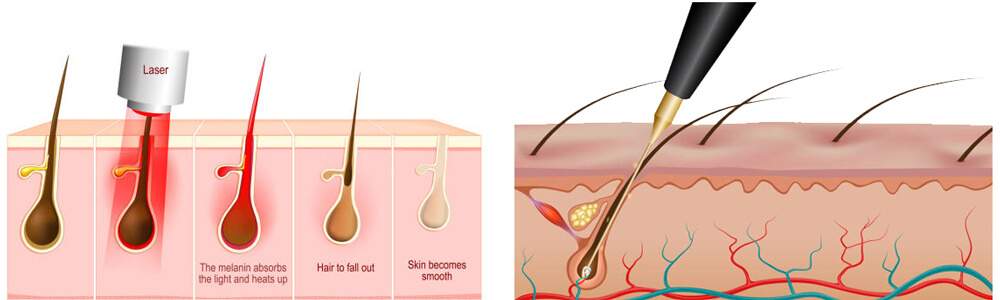 Laser hair removal vs. Electrolysis