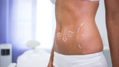 Female body with drawing arrows for abdomen liposuction