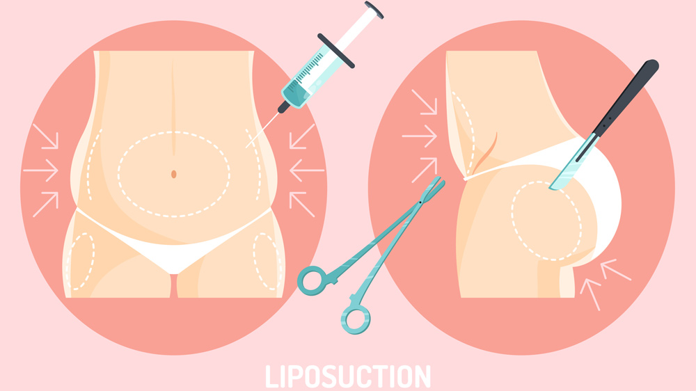 Liposuction