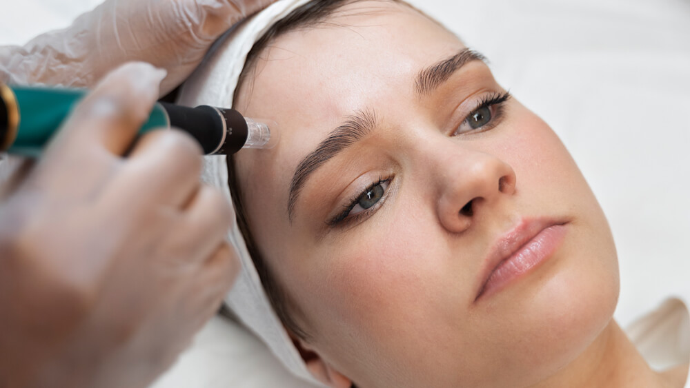 Collagen production stimulation in microneedling procedure on a woman's face