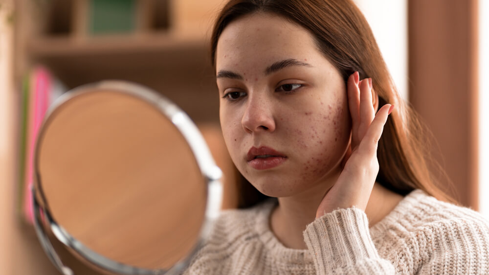 Worried person with acne scars looking at mirror