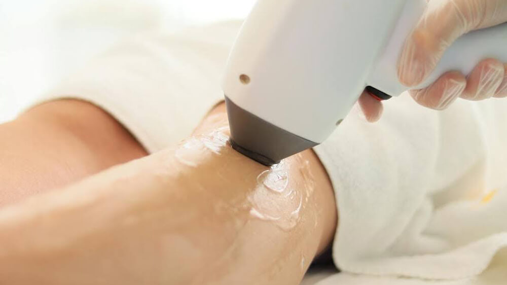 Closeup of diode laser hair removal procedure on leg