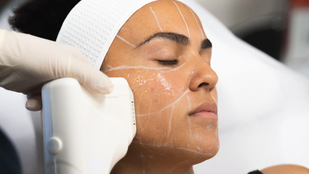 HIFU treatment procedure on woman's face