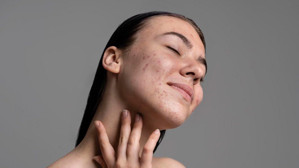 Beautiful young woman with acne