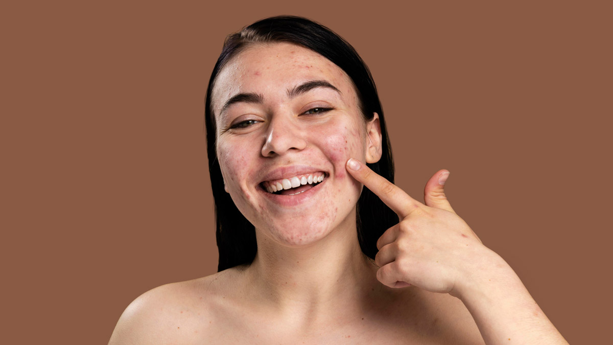 Smiley woman showing her acne with confidence