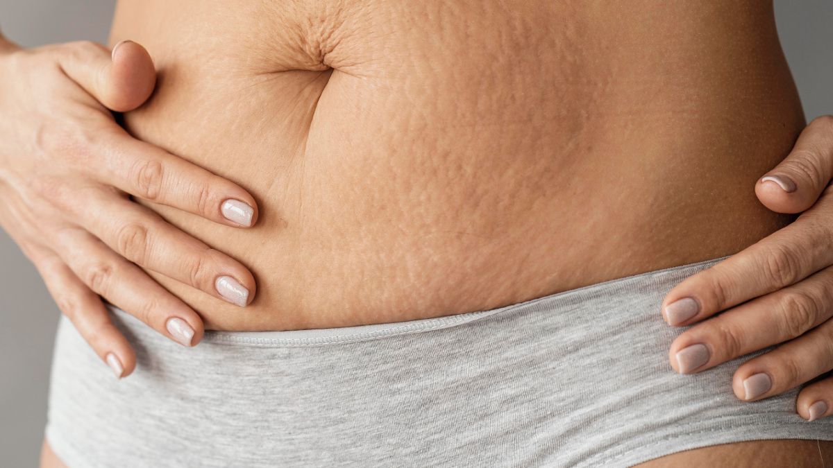 Close up of woman with stretch marks