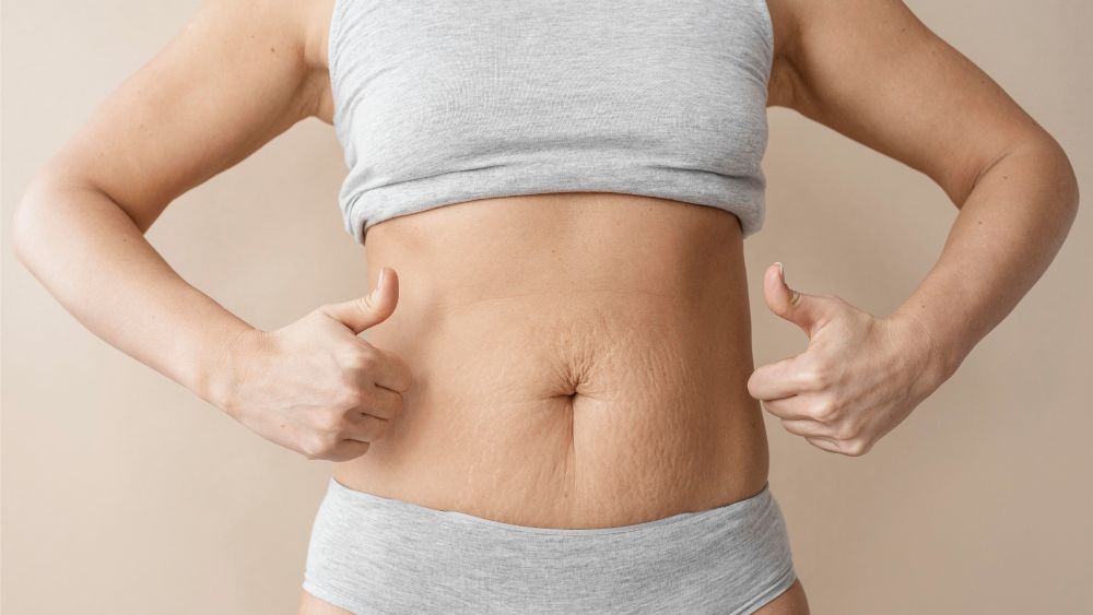 Woman with stretch marks and hands holding thumbs up