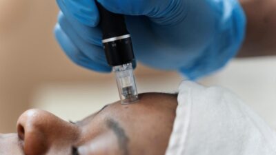 Person getting micro-needling treatment