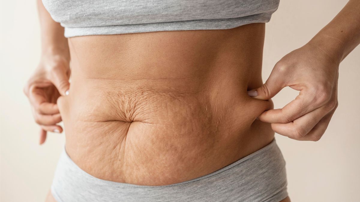 Close-up of hands holding belly skin with stretch marks