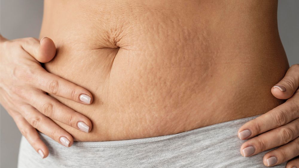 Close-up of a woman's belly with stretch marks