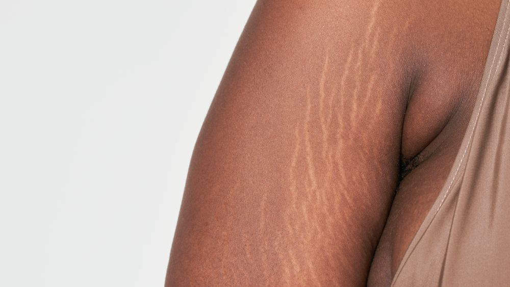 Dark skin woman arm's white stretch mark